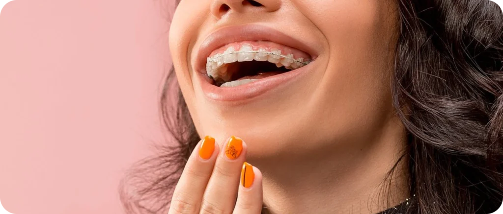 cabinet dentaire mandelieu la napoule orthodontie Appareils dentaires métal céramique Dr Mathelin Christel | Orthodontiste Mandelieu-la-Napoule