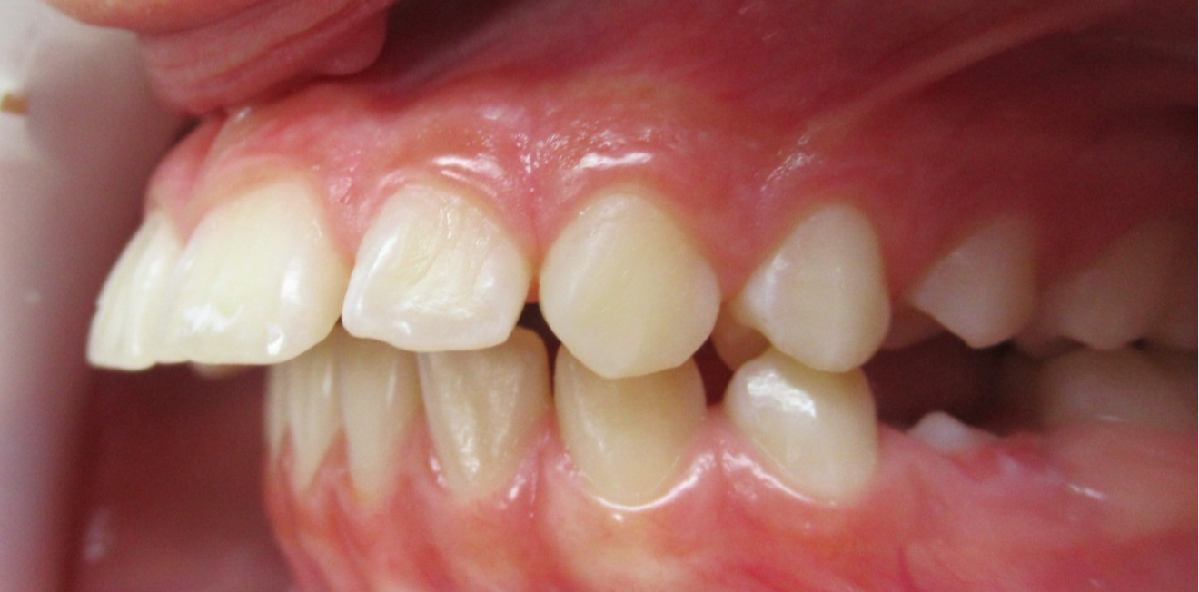 chevauchement dentaire mandelieu la napoule esthetique Cas clinique Dr Mathelin Christel | Orthodontiste Mandelieu-la-Napoule