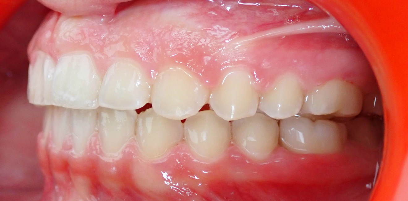 chevauchement dentaire mandelieu la napoule suivi Cas clinique Dr Mathelin Christel | Orthodontiste Mandelieu-la-Napoule