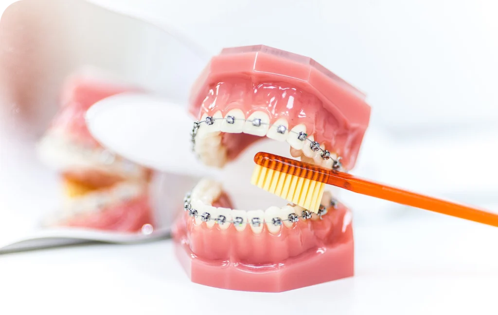 hygiene bucco dentaire mandelieu la napoule conseils Appareils dentaires métal céramique Dr Mathelin Christel | Orthodontiste Mandelieu-la-Napoule