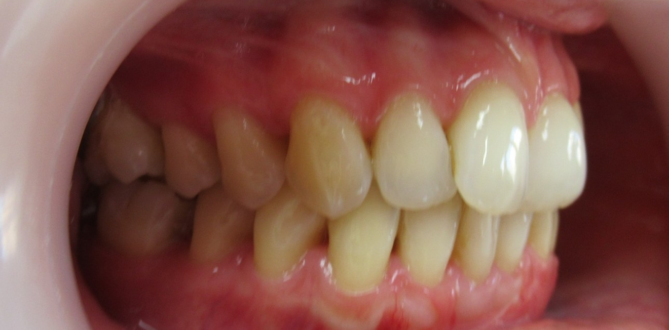 aligneurs transparents mandelieu la napoule alignement Cas clinique Dr Mathelin Christel | Orthodontiste Mandelieu-la-Napoule