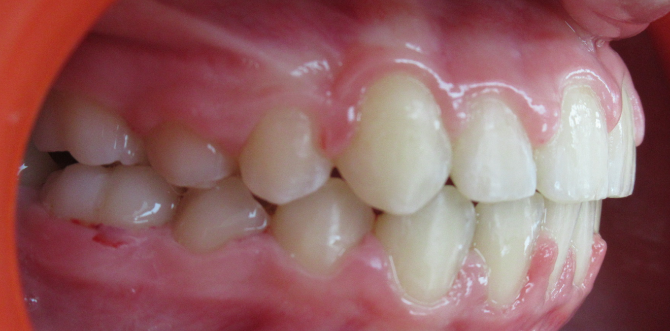 aligneurs transparents mandelieu la napoule confort Cas clinique Dr Mathelin Christel | Orthodontiste Mandelieu-la-Napoule