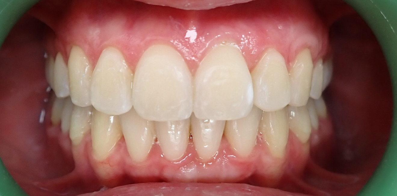 aligneurs transparents mandelieu la napoule confort Cas clinique Dr Mathelin Christel | Orthodontiste Mandelieu-la-Napoule
