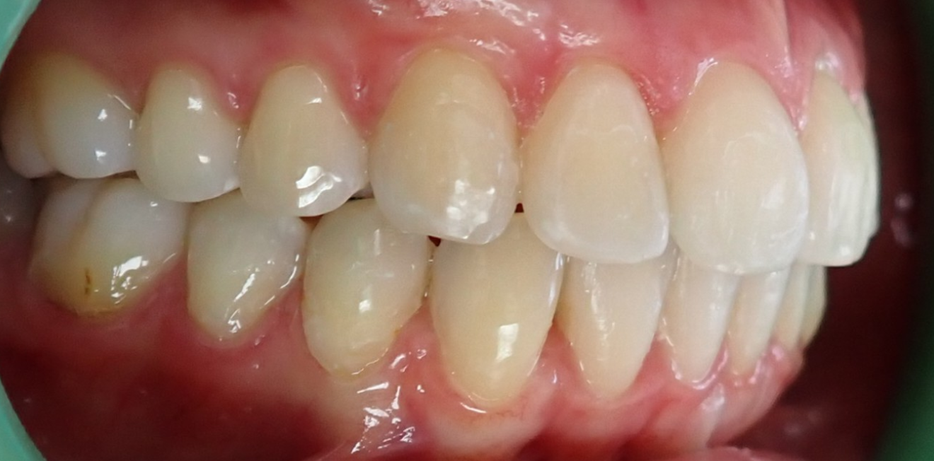 aligneurs transparents mandelieu la napoule esthetique Cas clinique Dr Mathelin Christel | Orthodontiste Mandelieu-la-Napoule