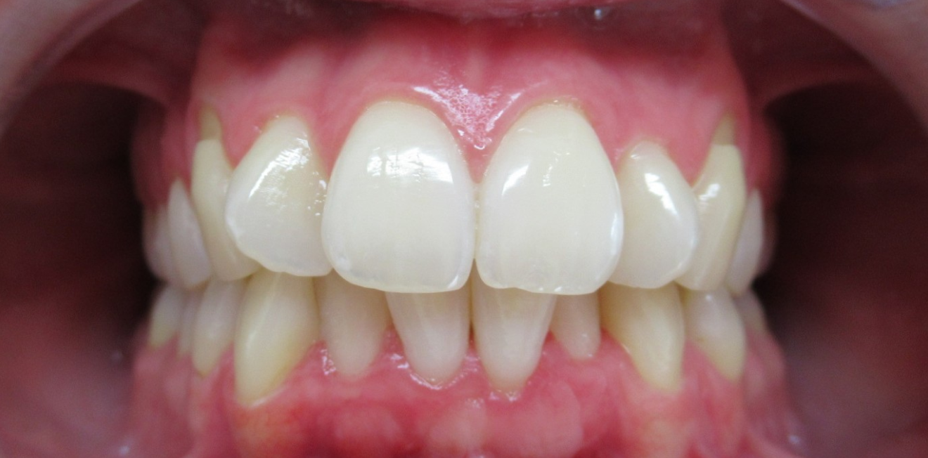 aligneurs transparents mandelieu la napoule precision Cas clinique Dr Mathelin Christel | Orthodontiste Mandelieu-la-Napoule