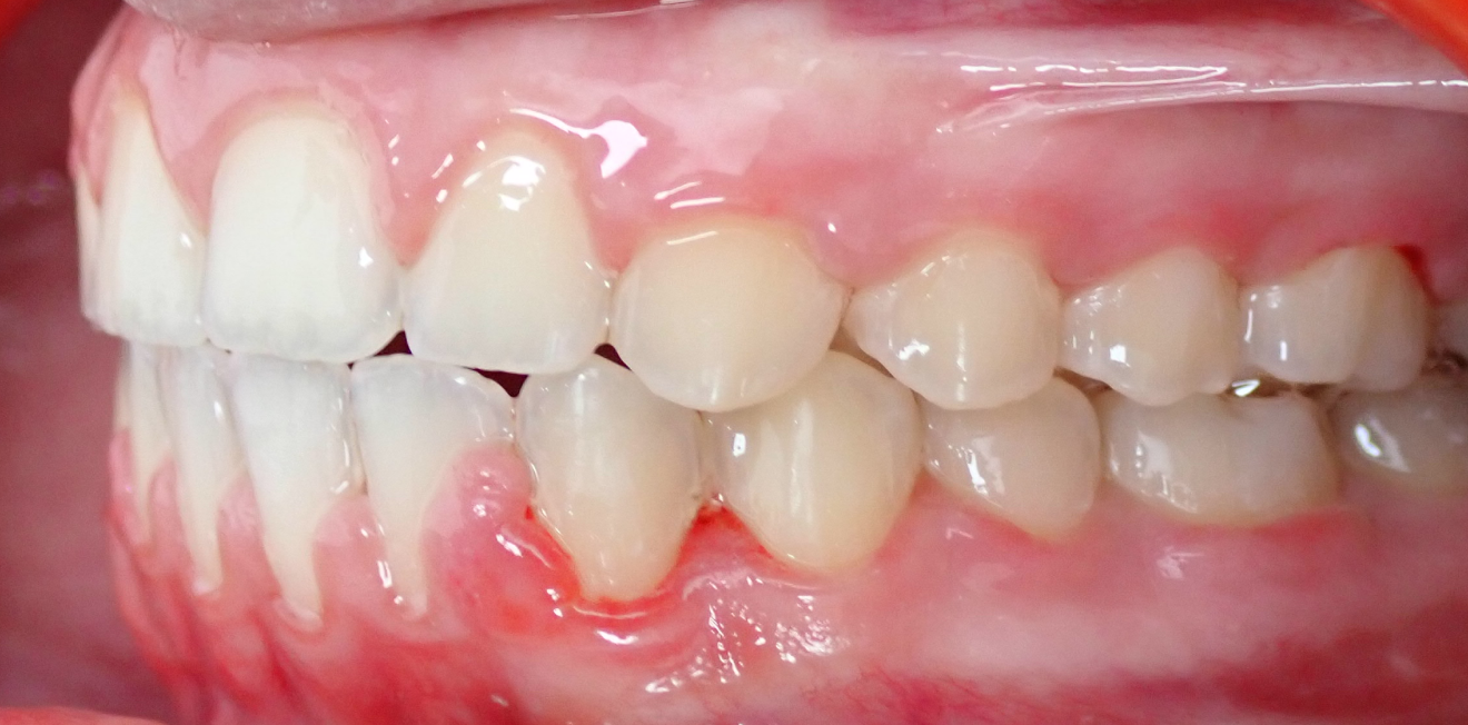 aligneurs transparents mandelieu la napoule sourire Cas clinique Dr Mathelin Christel | Orthodontiste Mandelieu-la-Napoule