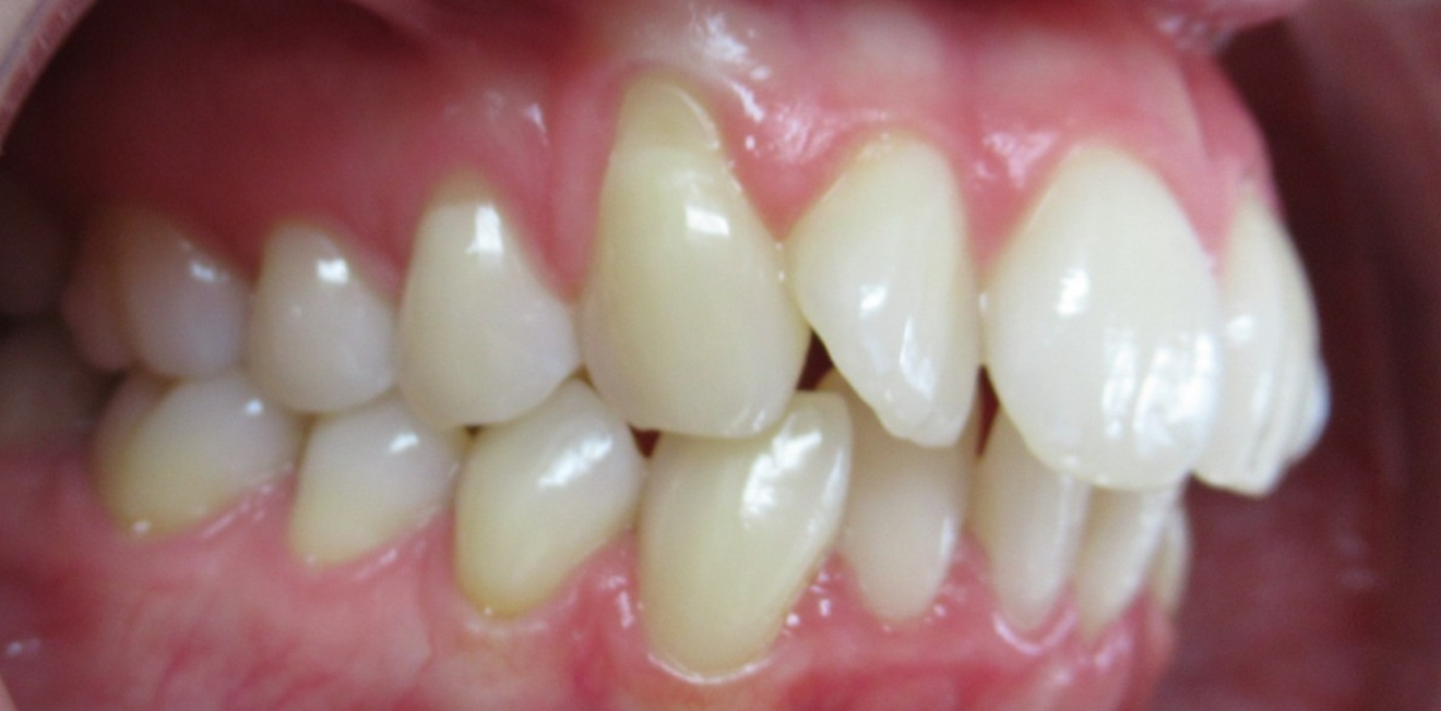 aligneurs transparents mandelieu la napoule sourire Cas clinique Dr Mathelin Christel | Orthodontiste Mandelieu-la-Napoule