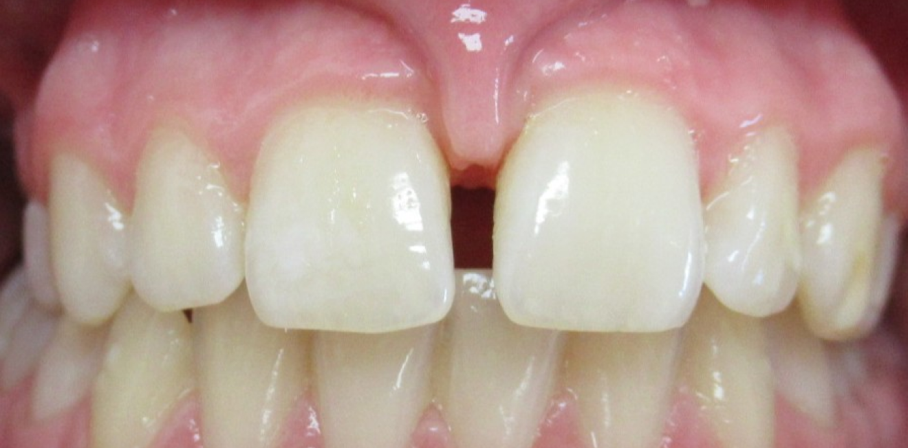 aligneurs transparents mandelieu la napoule stabilite Cas clinique Dr Mathelin Christel | Orthodontiste Mandelieu-la-Napoule