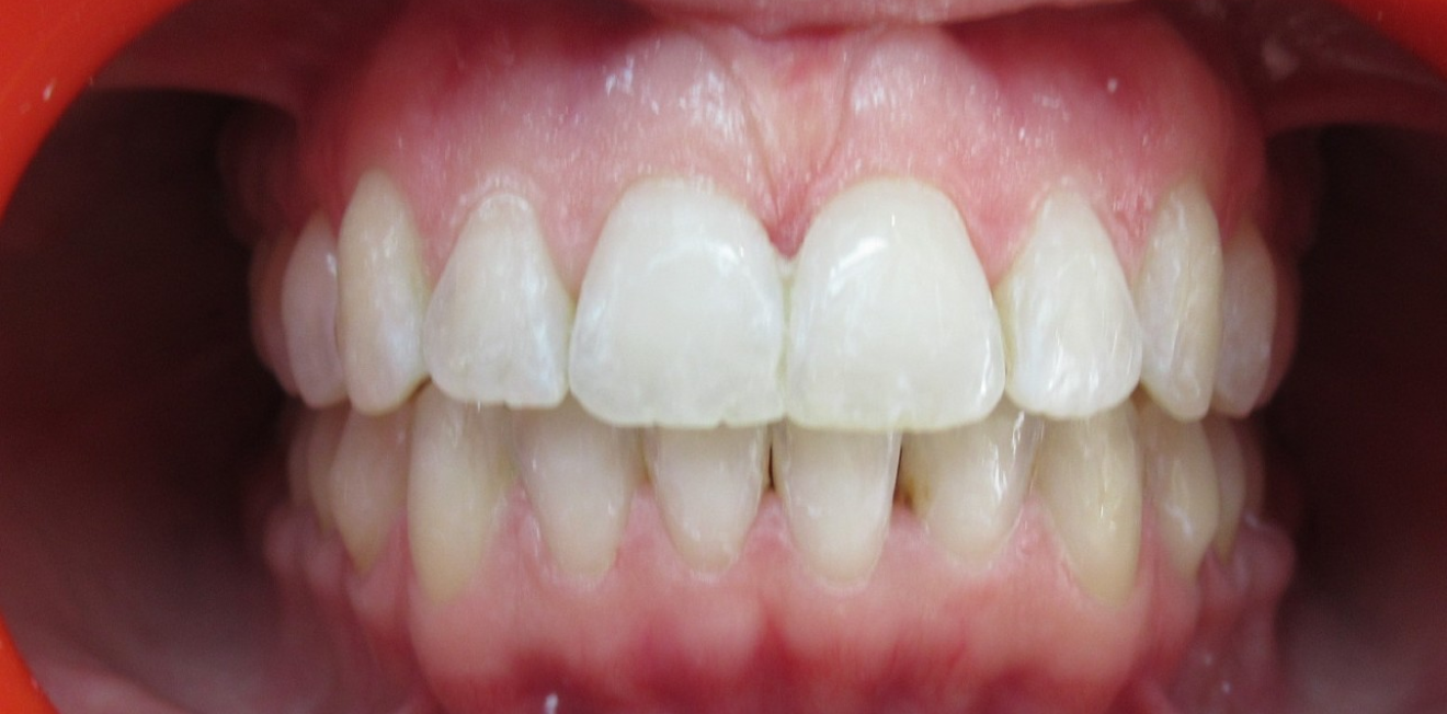 aligneurs transparents mandelieu la napoule traitement Cas clinique Dr Mathelin Christel | Orthodontiste Mandelieu-la-Napoule