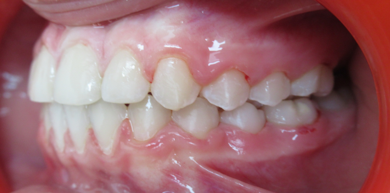 appareils dentaires mandelieu la napoule alignement Cas clinique Dr Mathelin Christel | Orthodontiste Mandelieu-la-Napoule