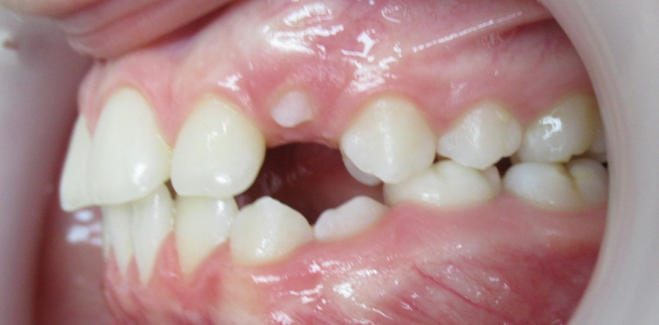 appareils dentaires mandelieu la napoule correction Cas clinique Dr Mathelin Christel | Orthodontiste Mandelieu-la-Napoule