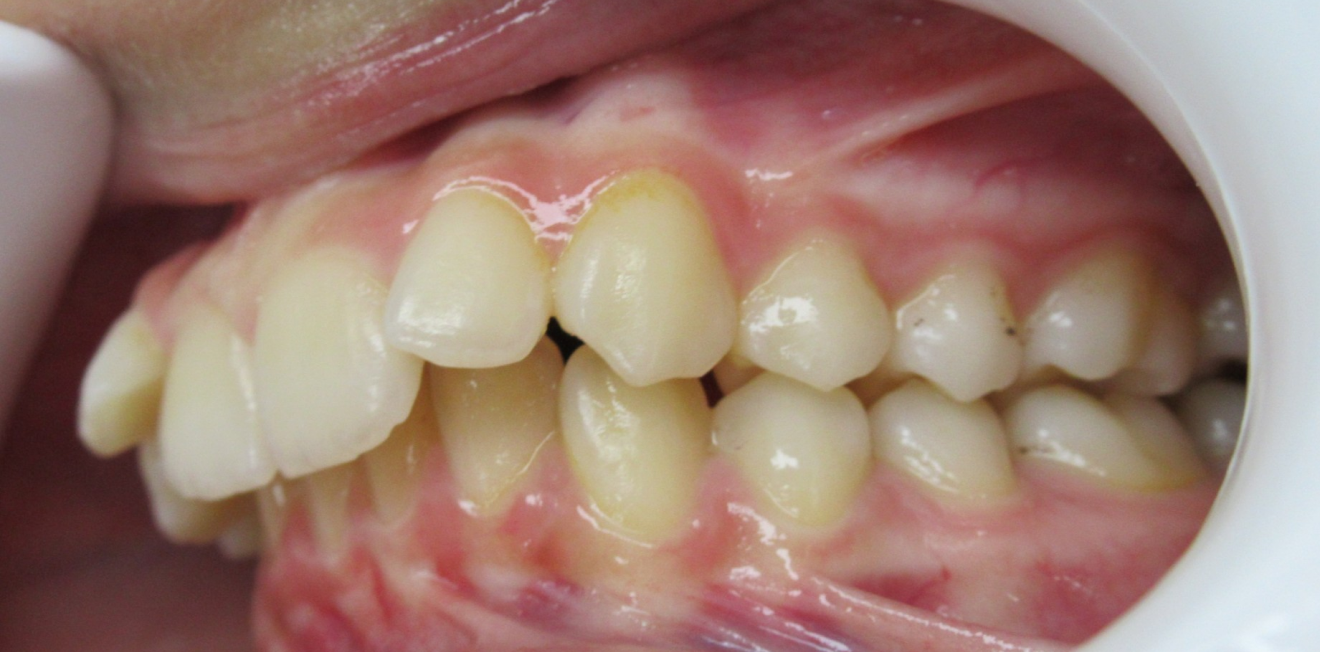 appareils dentaires mandelieu la napoule esthetique Cas clinique Dr Mathelin Christel | Orthodontiste Mandelieu-la-Napoule