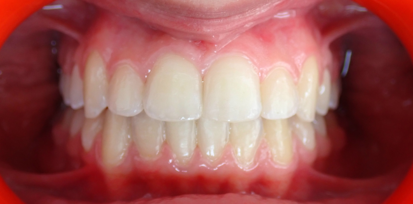 appareils dentaires mandelieu la napoule orthodontie Cas clinique Dr Mathelin Christel | Orthodontiste Mandelieu-la-Napoule