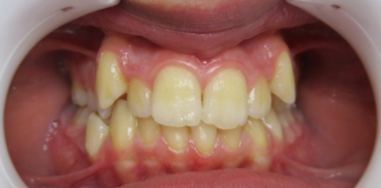 appareils dentaires mandelieu la napoule sourire Cas clinique Dr Mathelin Christel | Orthodontiste Mandelieu-la-Napoule