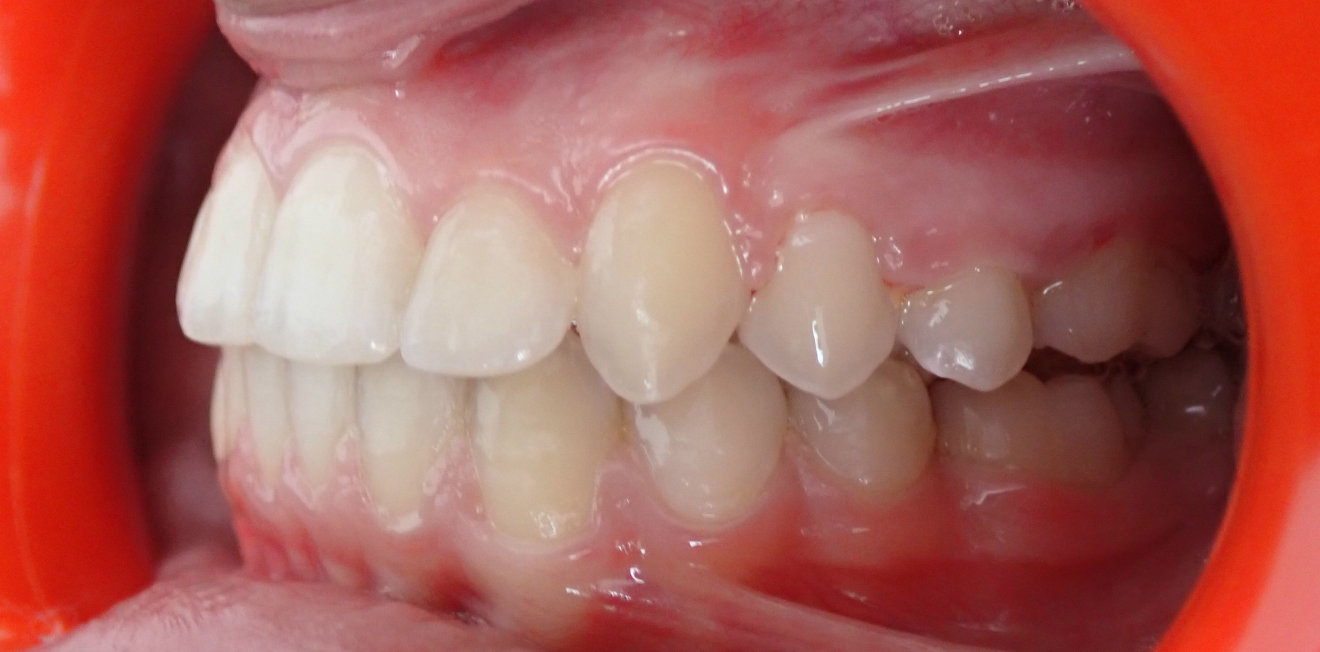 appareils dentaires mandelieu la napoule stabilite Cas clinique Dr Mathelin Christel | Orthodontiste Mandelieu-la-Napoule