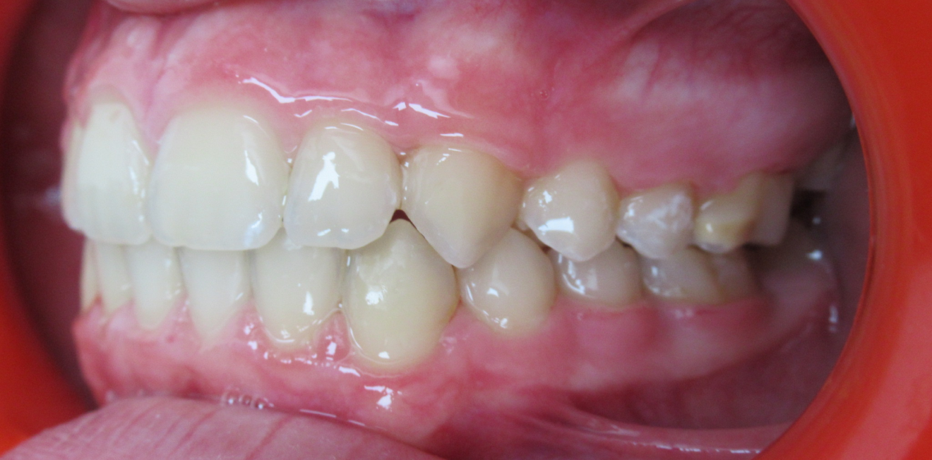 appareils dentaires mandelieu la napoule suivi Cas clinique Dr Mathelin Christel | Orthodontiste Mandelieu-la-Napoule