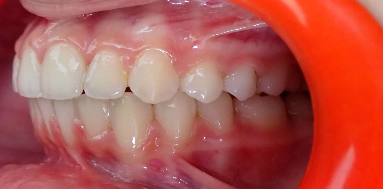 appareils dentaires mandelieu la napoule traitement Cas clinique Dr Mathelin Christel | Orthodontiste Mandelieu-la-Napoule