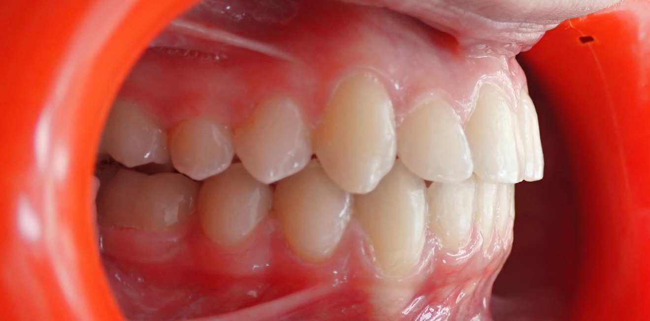 appareils dentaires metal ceramique mandelieu la napoule alignement Cas clinique Dr Mathelin Christel | Orthodontiste Mandelieu-la-Napoule