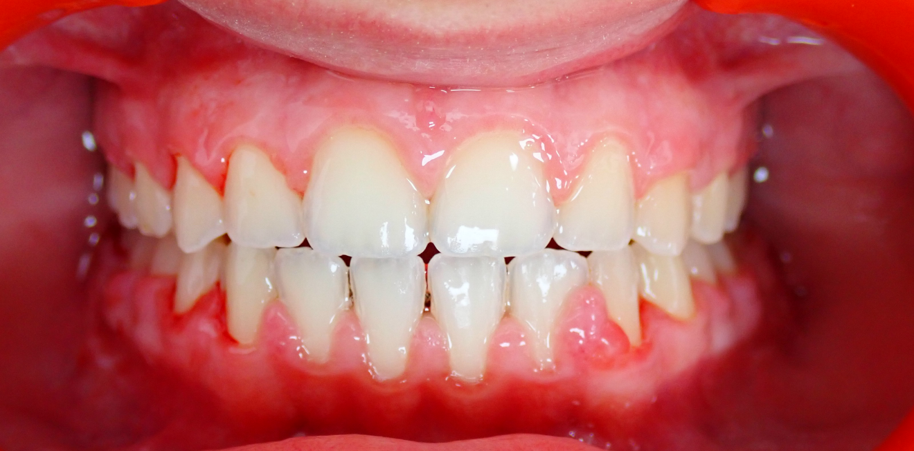 appareils dentaires metal ceramique mandelieu la napoule correction Cas clinique Dr Mathelin Christel | Orthodontiste Mandelieu-la-Napoule