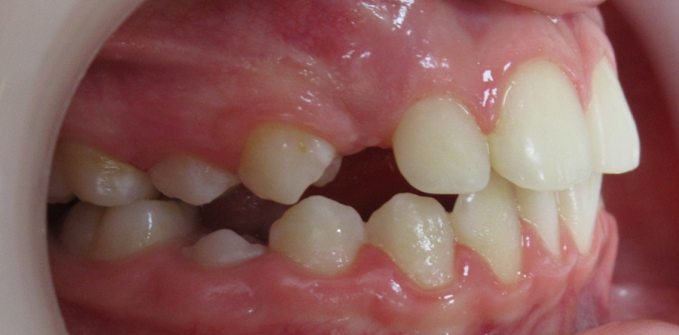 appareils dentaires metal ceramique mandelieu la napoule esthetique Cas clinique Dr Mathelin Christel | Orthodontiste Mandelieu-la-Napoule