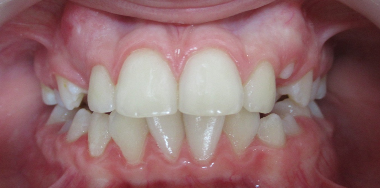 appareils dentaires metal ceramique mandelieu la napoule precision Cas clinique Dr Mathelin Christel | Orthodontiste Mandelieu-la-Napoule