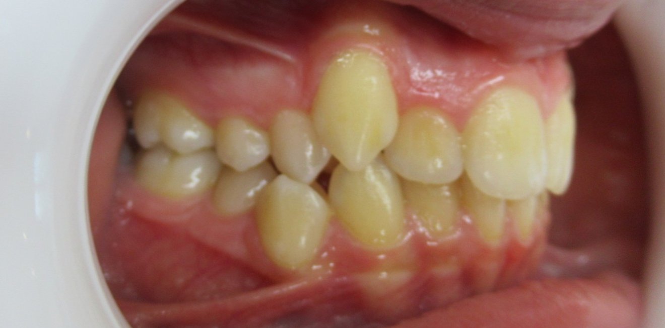 appareils dentaires metal ceramique mandelieu la napoule sourire Cas clinique Dr Mathelin Christel | Orthodontiste Mandelieu-la-Napoule