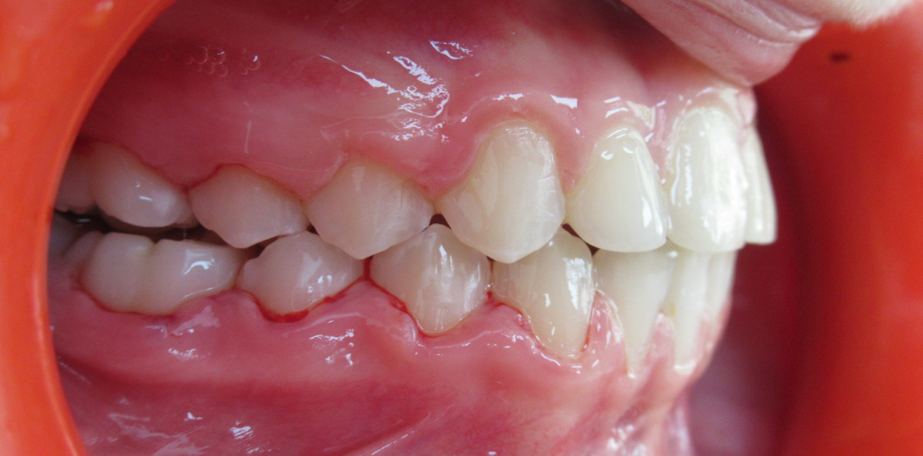 appareils dentaires metal ceramique mandelieu la napoule stabilite Cas clinique Dr Mathelin Christel | Orthodontiste Mandelieu-la-Napoule