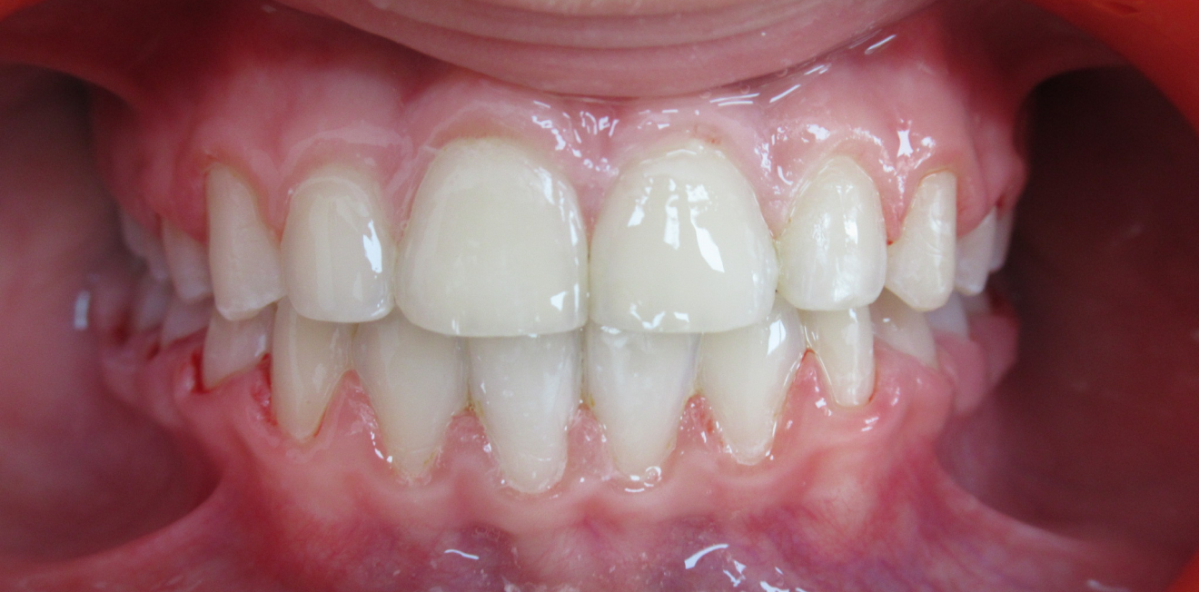 appareils dentaires metal ceramique mandelieu la napoule traitement Cas clinique Dr Mathelin Christel | Orthodontiste Mandelieu-la-Napoule