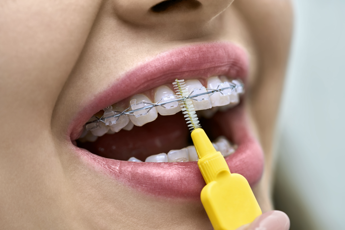 brossage appareil dentaire Hygiène avec un appareil dentaire Dr Mathelin Christel | Orthodontiste Mandelieu-la-Napoule