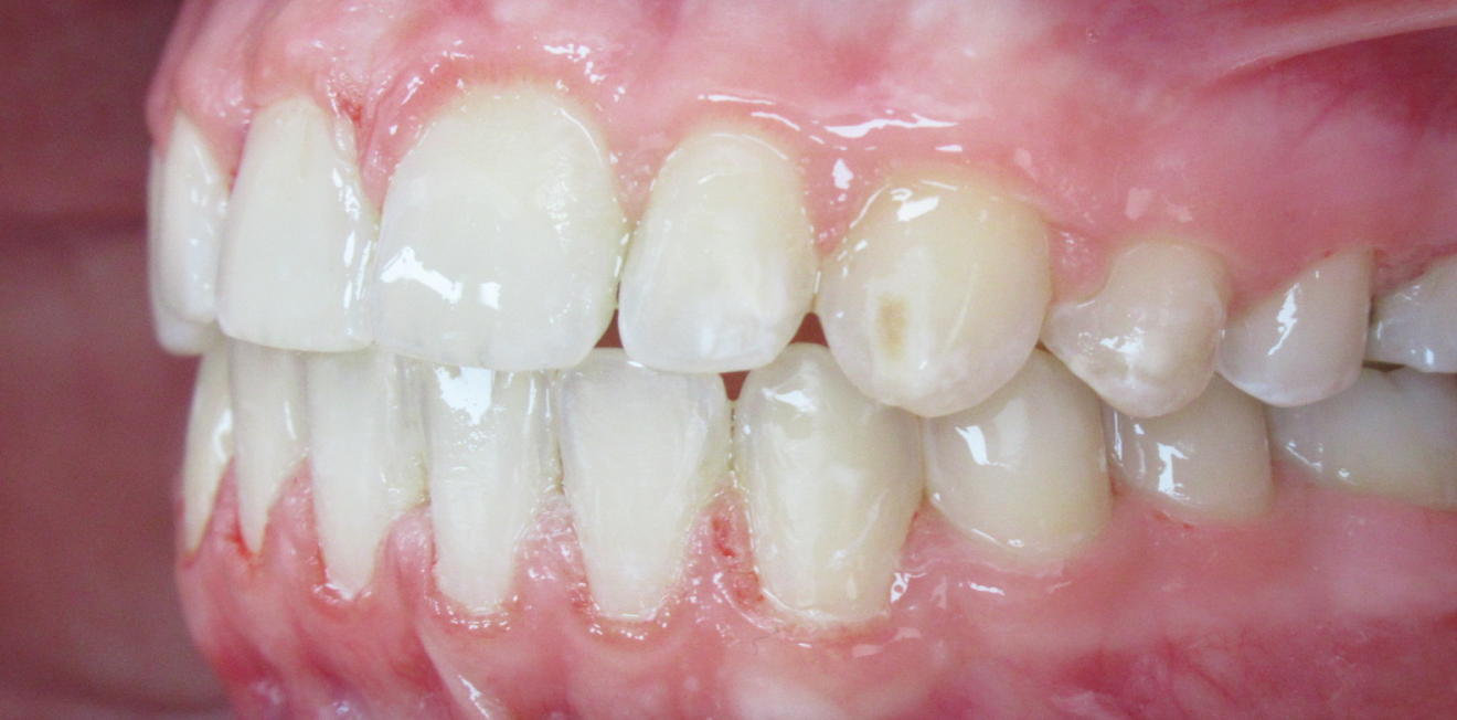 cabinet dentaire mandelieu la napoule esthetique dentaire Cas clinique Dr Mathelin Christel | Orthodontiste Mandelieu-la-Napoule