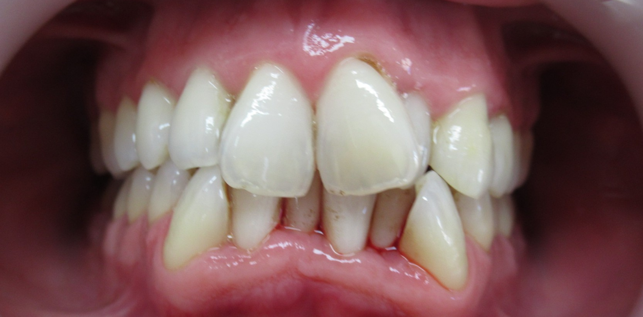 chevauchement dentaire mandelieu la napoule adultes Cas clinique Dr Mathelin Christel | Orthodontiste Mandelieu-la-Napoule