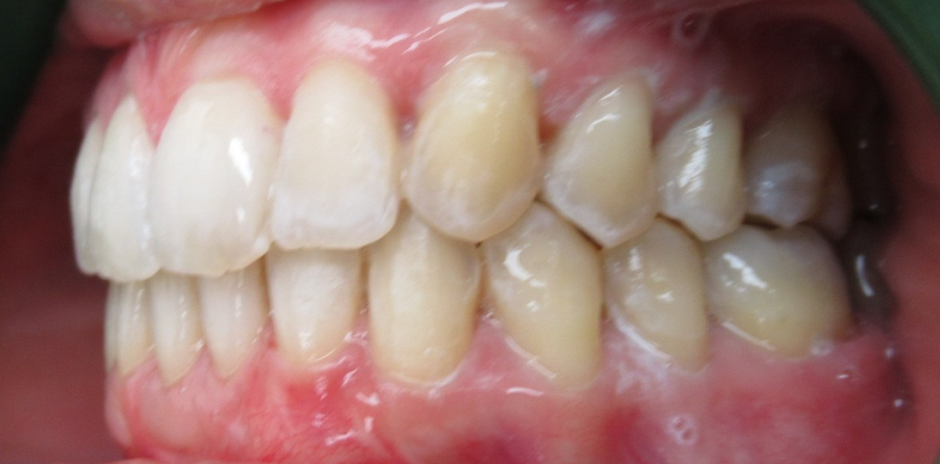 chevauchement dentaire mandelieu la napoule correction Cas clinique Dr Mathelin Christel | Orthodontiste Mandelieu-la-Napoule