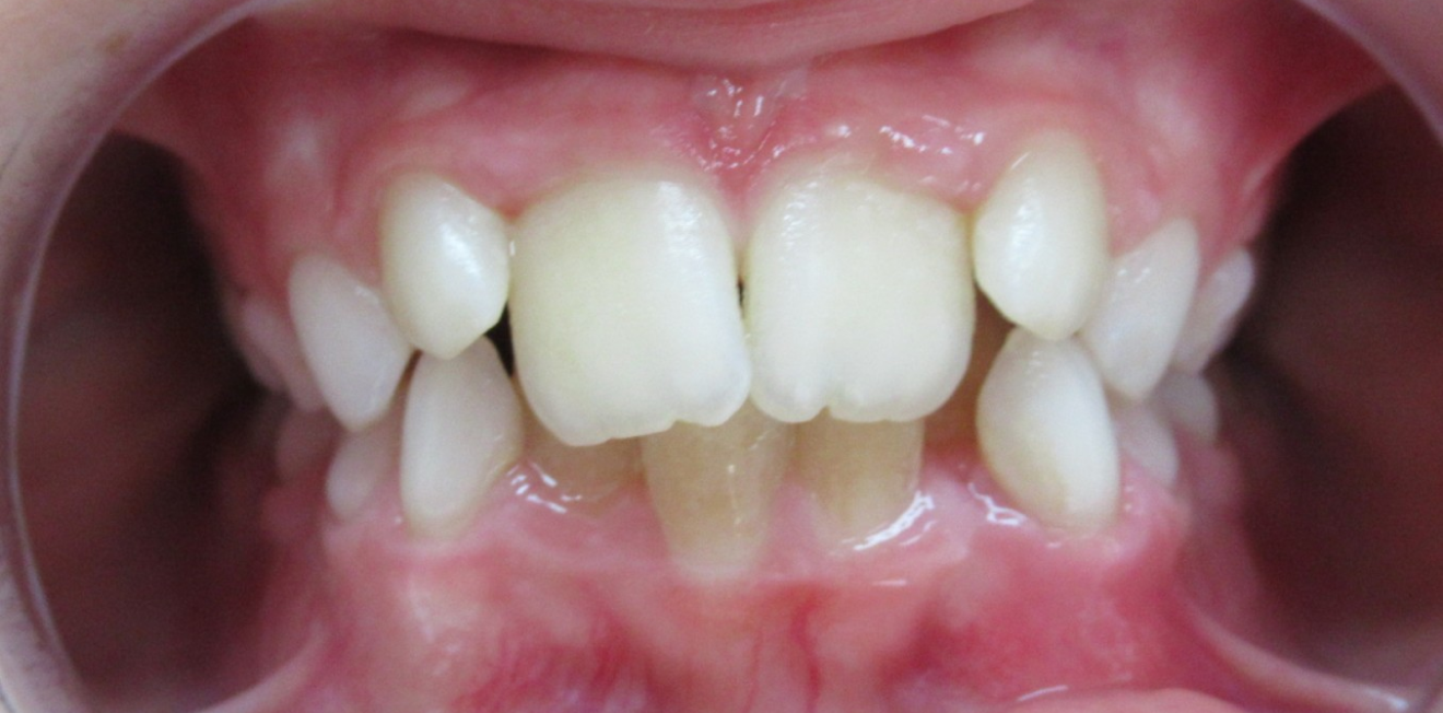 chevauchement dentaire mandelieu la napoule diagnostic Cas clinique Dr Mathelin Christel | Orthodontiste Mandelieu-la-Napoule