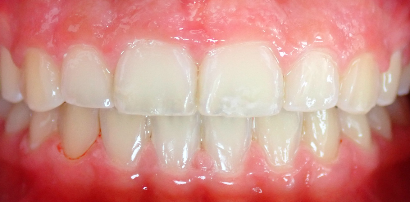 chevauchement dentaire mandelieu la napoule equilibre Cas clinique Dr Mathelin Christel | Orthodontiste Mandelieu-la-Napoule