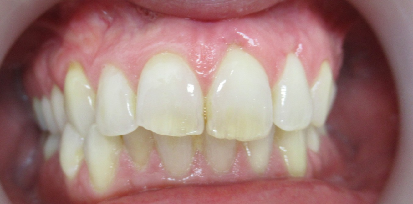 chevauchement dentaire mandelieu la napoule esthetique Cas clinique Dr Mathelin Christel | Orthodontiste Mandelieu-la-Napoule