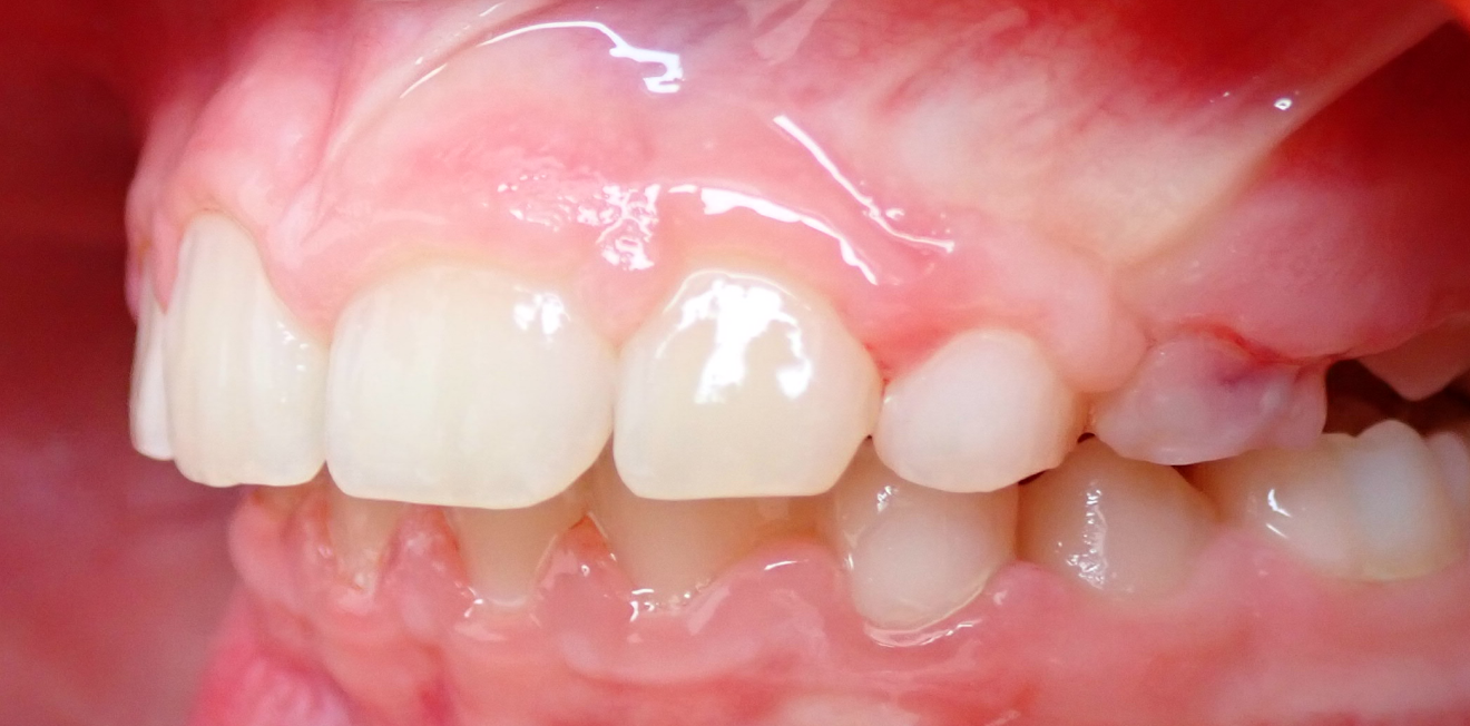 chevauchement dentaire mandelieu la napoule evaluation Cas clinique Dr Mathelin Christel | Orthodontiste Mandelieu-la-Napoule