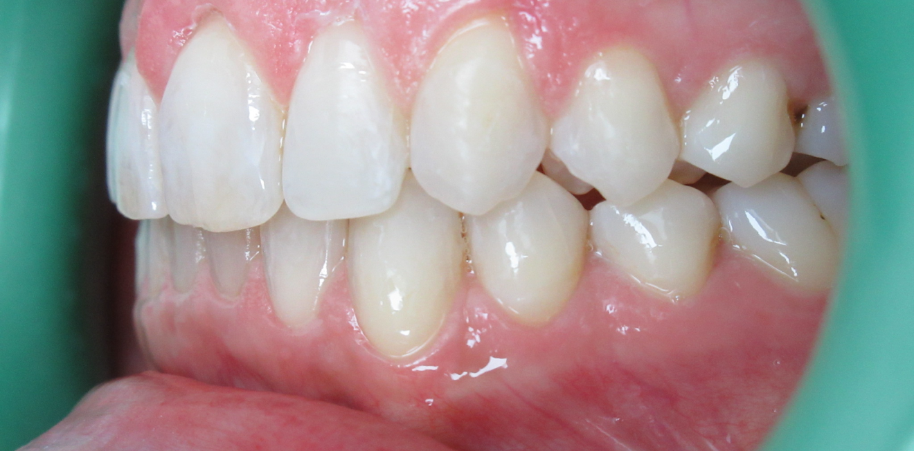 chevauchement dentaire mandelieu la napoule harmonie Cas clinique Dr Mathelin Christel | Orthodontiste Mandelieu-la-Napoule