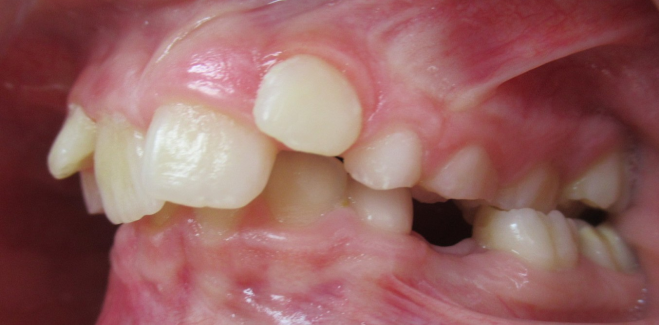 chevauchement dentaire mandelieu la napoule prise charge Cas clinique Dr Mathelin Christel | Orthodontiste Mandelieu-la-Napoule