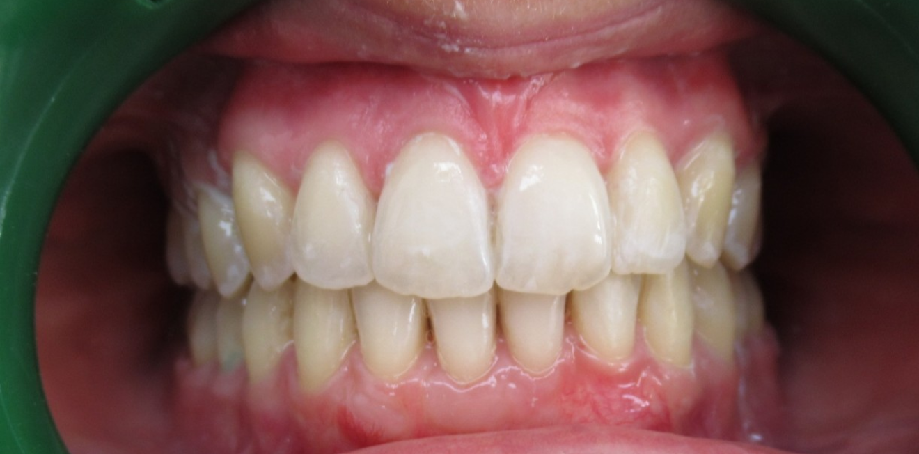 chevauchement dentaire mandelieu la napoule stabilite Cas clinique Dr Mathelin Christel | Orthodontiste Mandelieu-la-Napoule