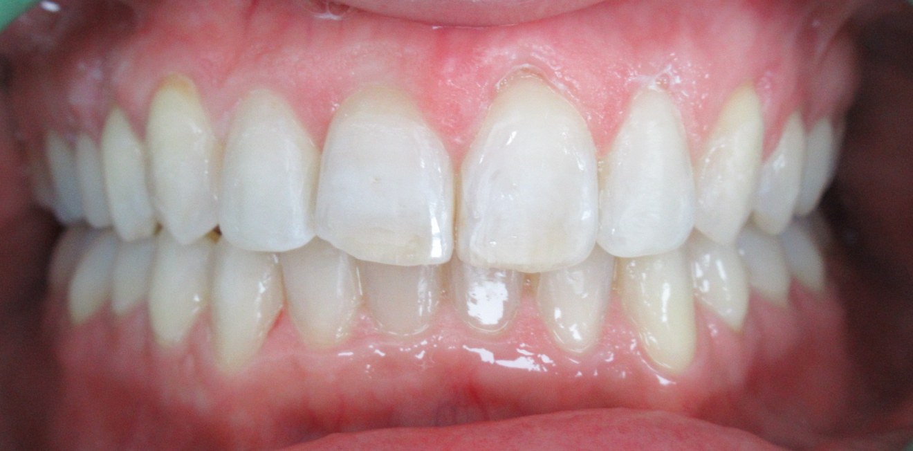 chevauchement dentaire mandelieu la napoule suivi Cas clinique Dr Mathelin Christel | Orthodontiste Mandelieu-la-Napoule