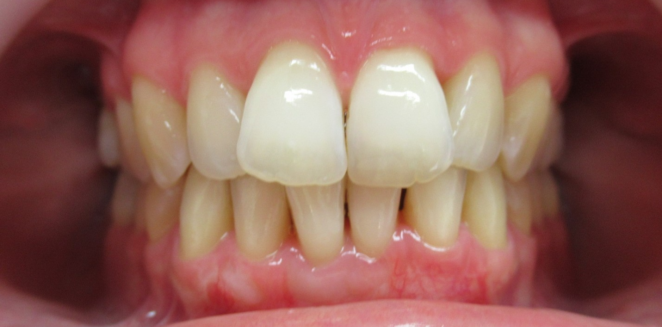 chevauchement dentaire mandelieu la napoule traitement Cas clinique Dr Mathelin Christel | Orthodontiste Mandelieu-la-Napoule