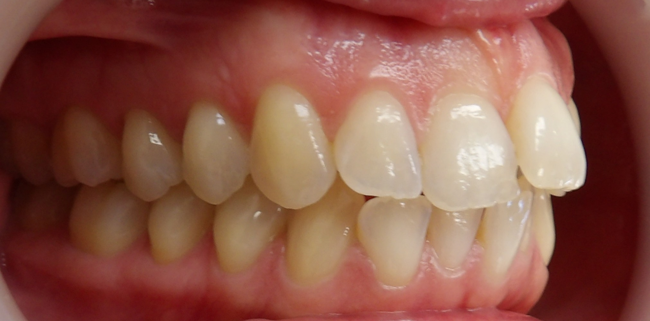 chevauchement dentaire mandelieu la napoule Cas clinique Dr Mathelin Christel | Orthodontiste Mandelieu-la-Napoule