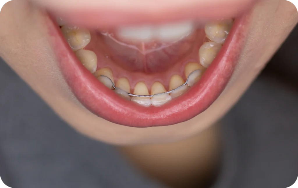 contention mandelieu la napoule protection sourire L’importance de la contention Dr Mathelin Christel | Orthodontiste Mandelieu-la-Napoule