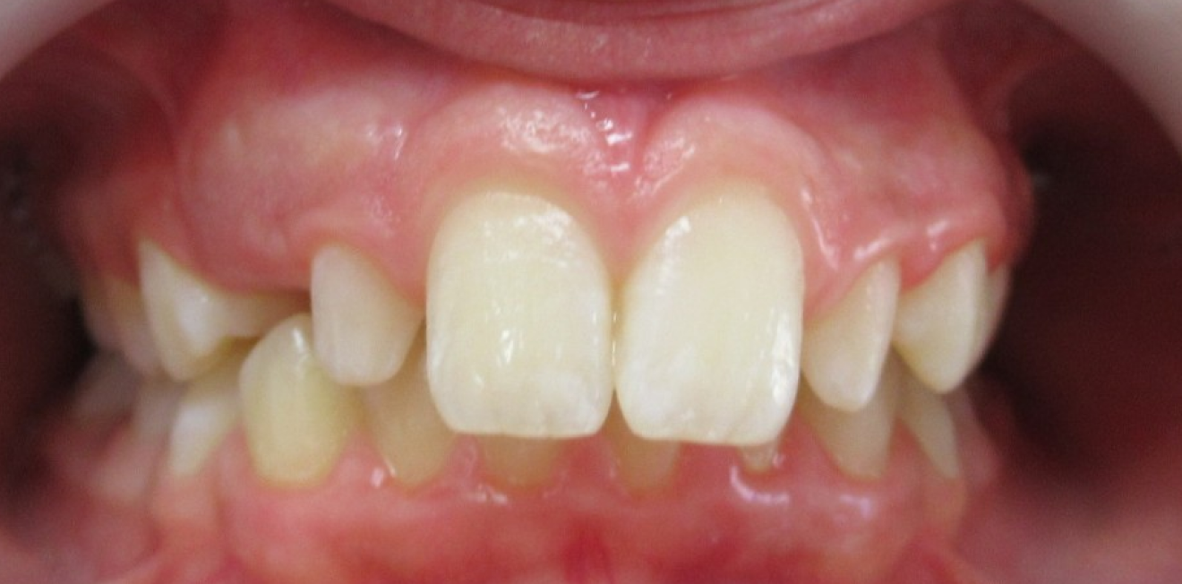 contention mandelieu la napoule stabilite dentaire Cas clinique Dr Mathelin Christel | Orthodontiste Mandelieu-la-Napoule