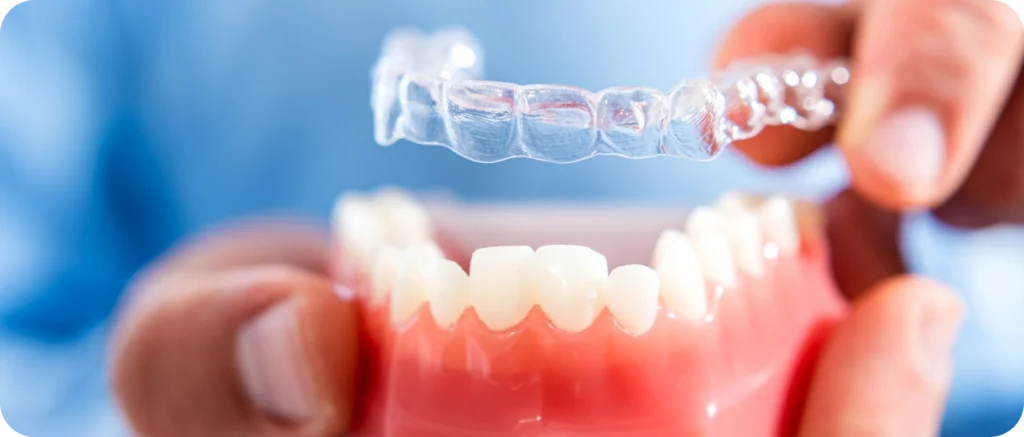 contention mandelieu la napoule suivi posttraitement L’importance de la contention Dr Mathelin Christel | Orthodontiste Mandelieu-la-Napoule