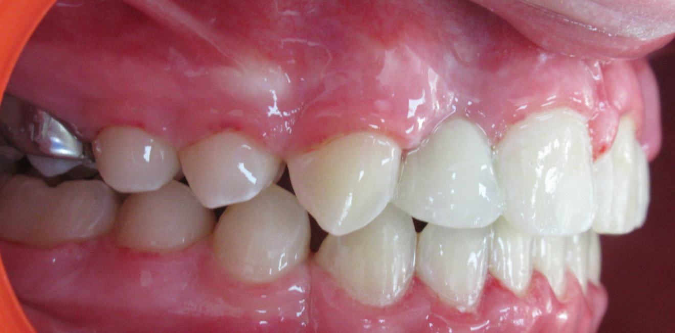 disjoncteur maxillaire mandelieu la napoule correction Cas clinique Dr Mathelin Christel | Orthodontiste Mandelieu-la-Napoule