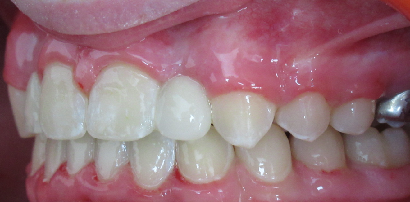 disjoncteur maxillaire mandelieu la napoule croissance Cas clinique Dr Mathelin Christel | Orthodontiste Mandelieu-la-Napoule