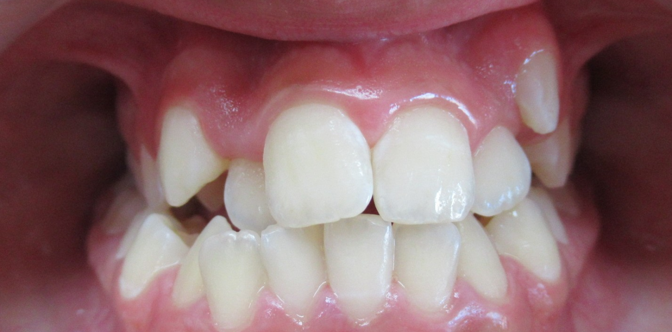 disjoncteur maxillaire mandelieu la napoule expansion Cas clinique Dr Mathelin Christel | Orthodontiste Mandelieu-la-Napoule