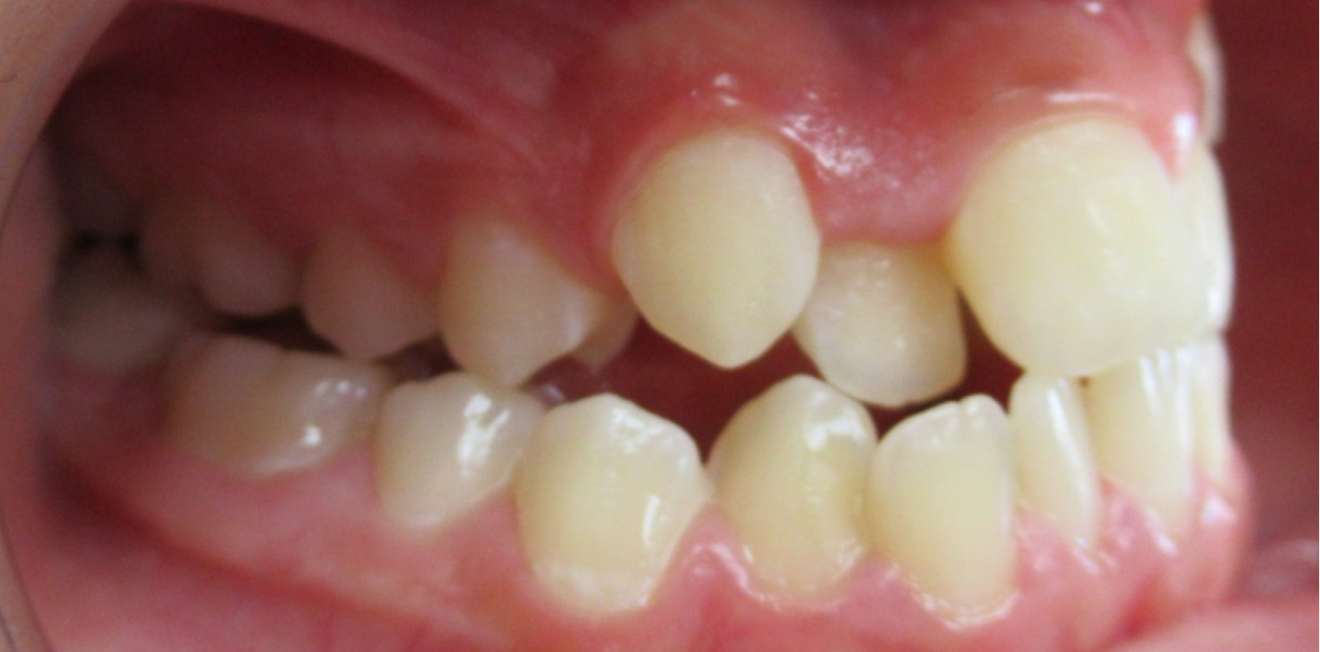 disjoncteur maxillaire mandelieu la napoule orthodontie Cas clinique Dr Mathelin Christel | Orthodontiste Mandelieu-la-Napoule