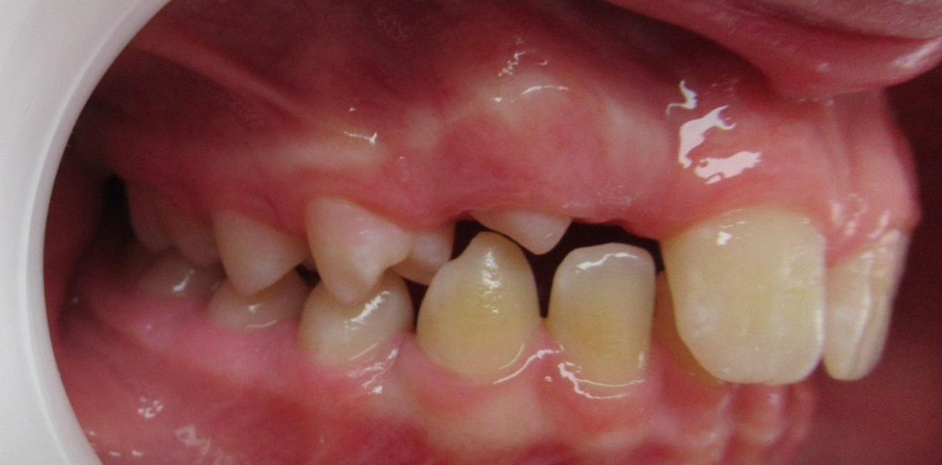 disjoncteur maxillaire mandelieu la napoule palais Cas clinique Dr Mathelin Christel | Orthodontiste Mandelieu-la-Napoule